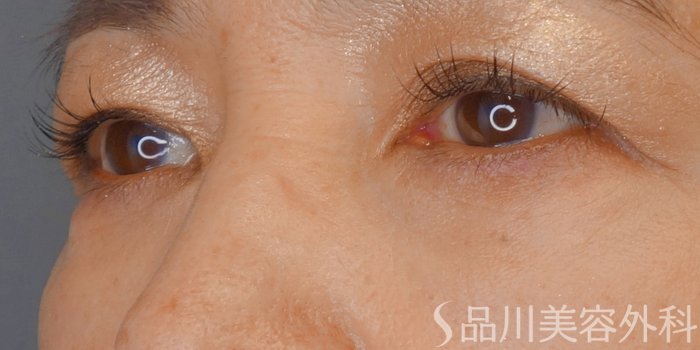 症例NO.72222のAFTER写真