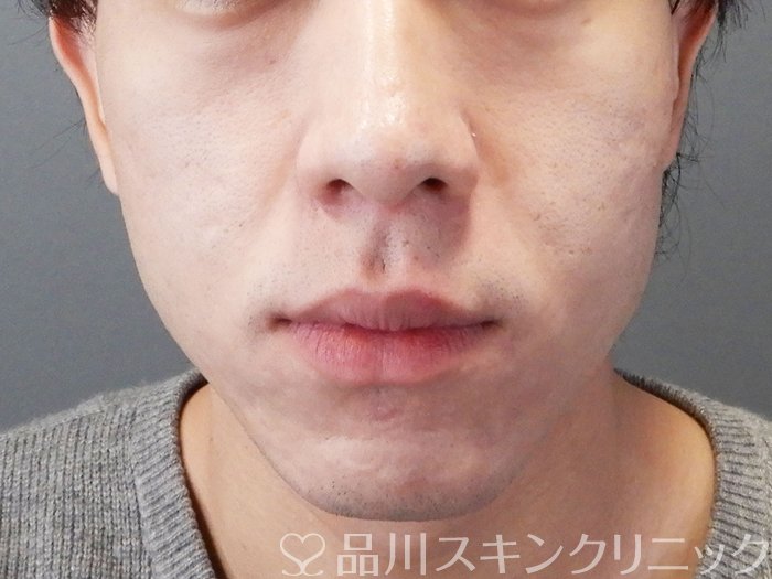 症例NO.73208のAFTER写真