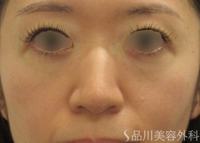 症例NO.72267のBEFORE写真