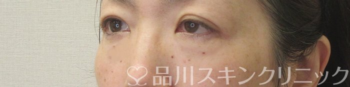 症例NO.72408のAFTER写真