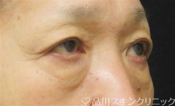 症例NO.61825のBEFORE写真