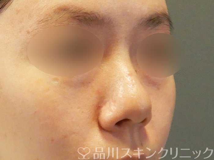 症例NO.70098のBEFORE写真