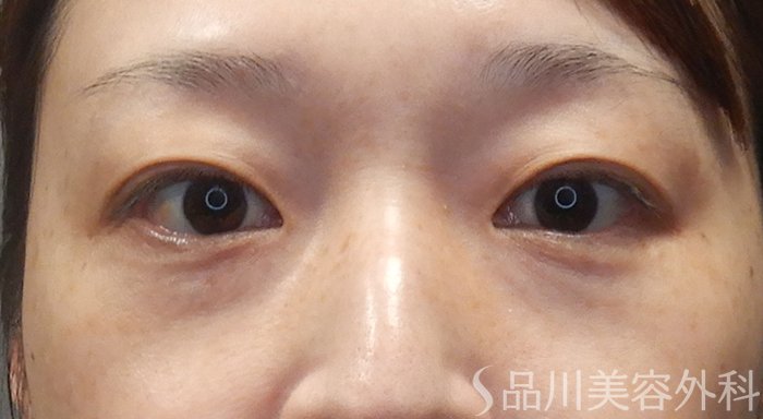 症例NO.72003のBEFORE写真