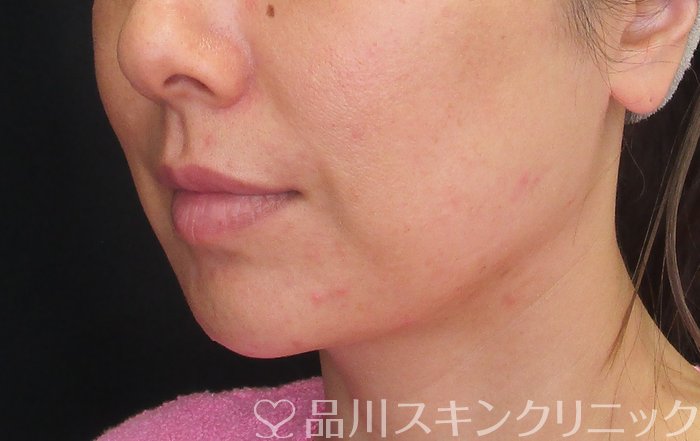 症例NO.74862のBEFORE写真