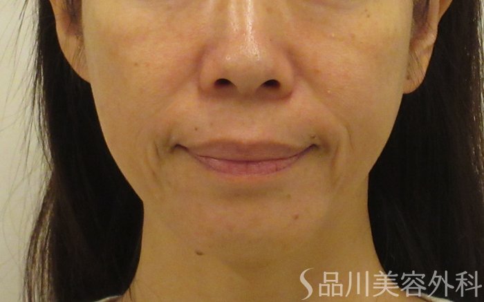 症例NO.72101のBEFORE写真