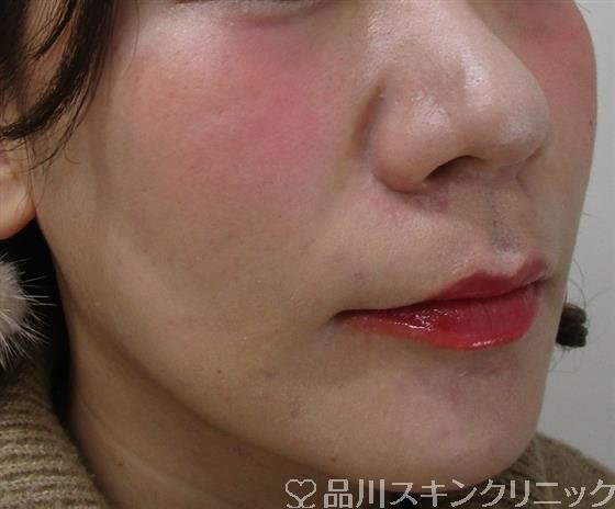 症例NO.45330のAFTER写真