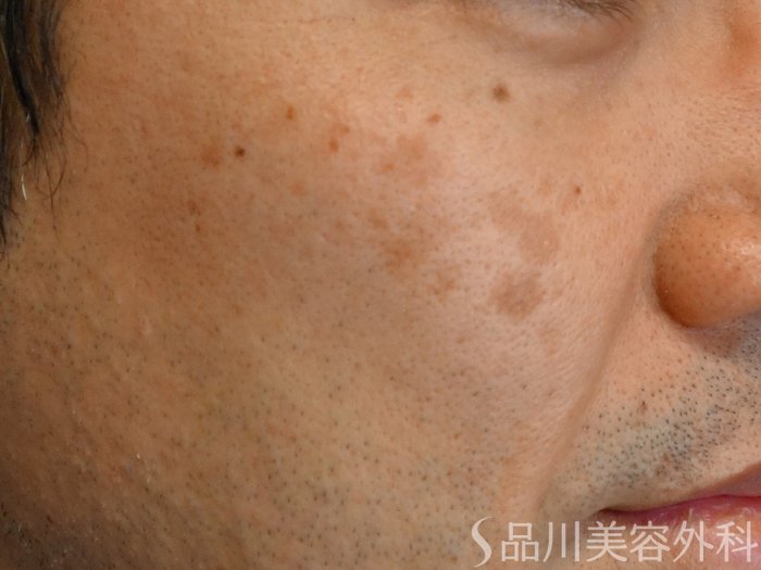 症例NO.74814のBEFORE写真