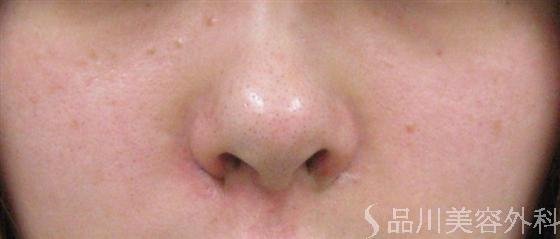 症例NO.6818のAFTER写真
