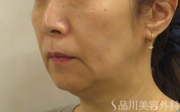 症例NO.72764のBEFORE写真