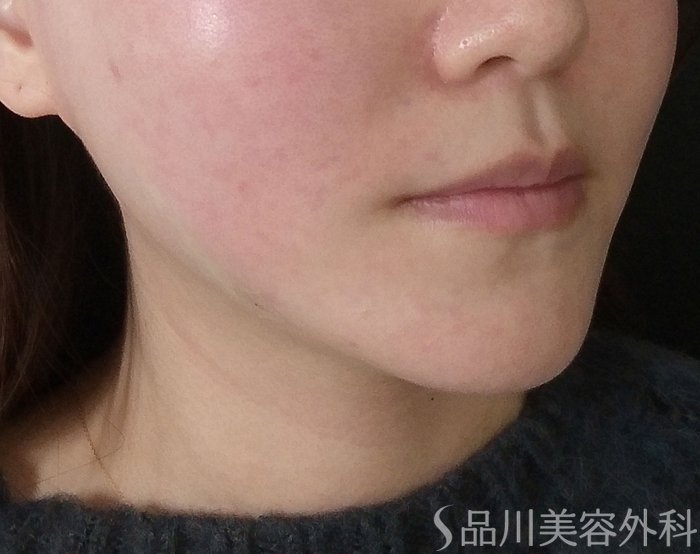 症例NO.73392のAFTER写真