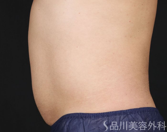 症例NO.71756のAFTER写真