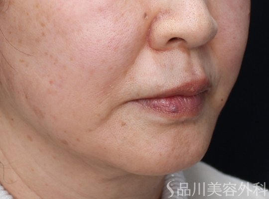 症例NO.73764のAFTER写真