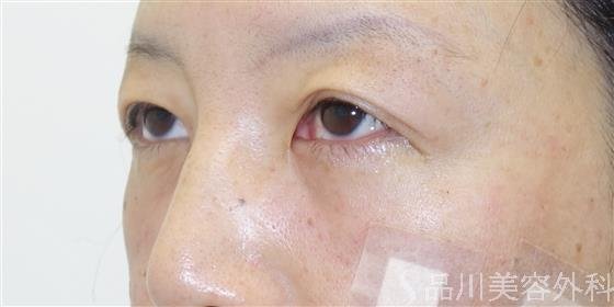 症例NO.41410のAFTER写真