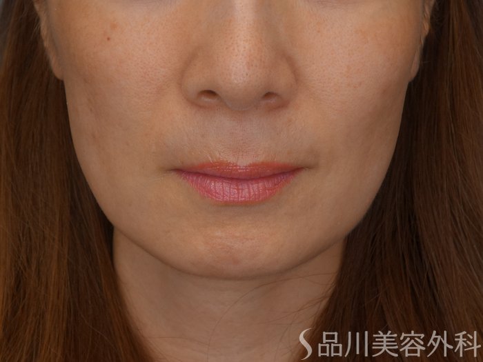 症例NO.72503のBEFORE写真