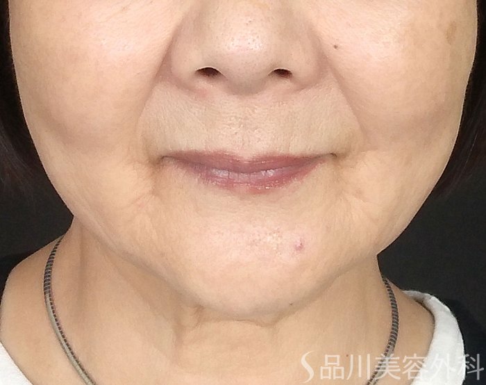症例NO.69220のAFTER写真