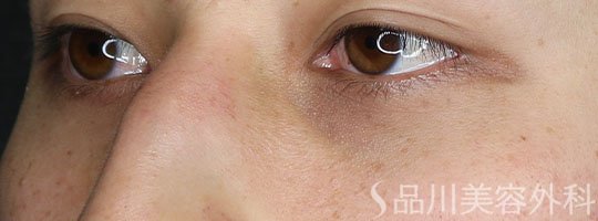 症例NO.72639のAFTER写真