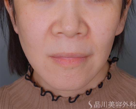 症例NO.53310のBEFORE写真
