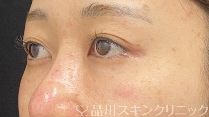 症例NO.74381のAFTER写真