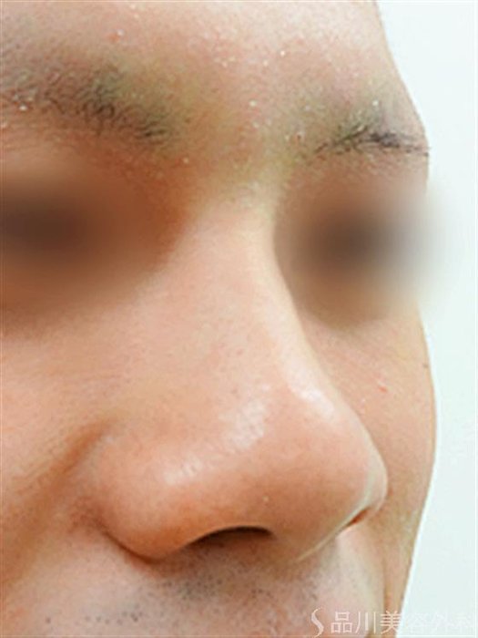 症例NO.23230のBEFORE写真