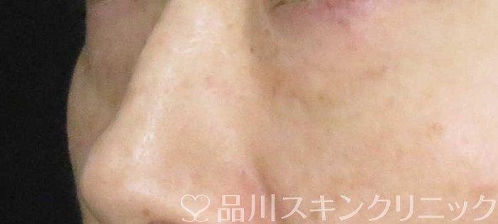 症例NO.65662のBEFORE写真