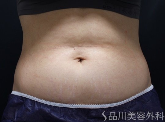 症例NO.68246のBEFORE写真