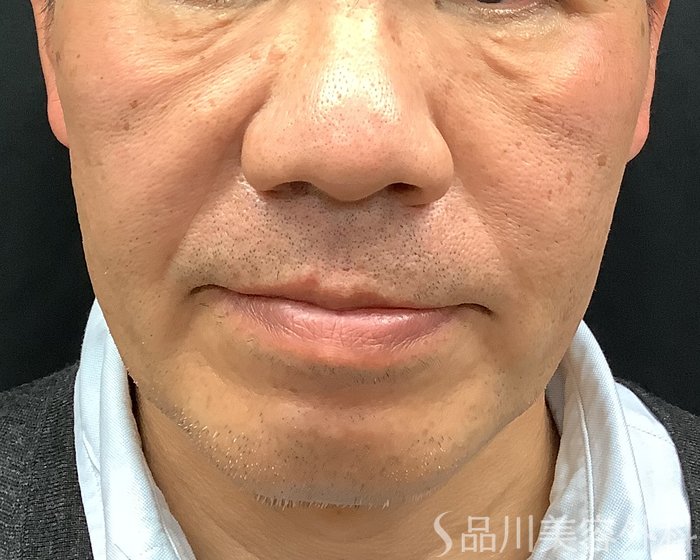症例NO.69643のBEFORE写真