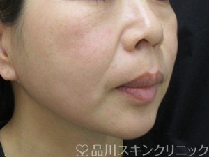 症例NO.74285のBEFORE写真