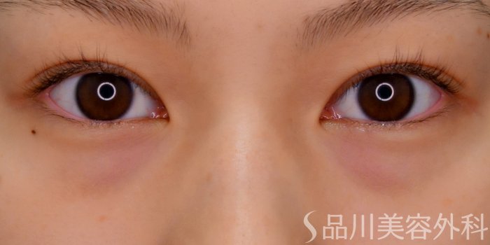 症例NO.69651のBEFORE写真