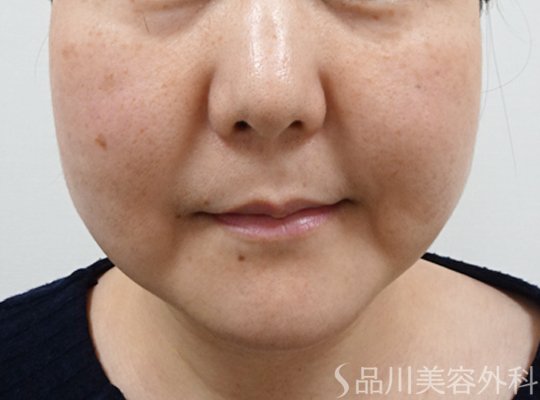 症例NO.64977のBEFORE写真