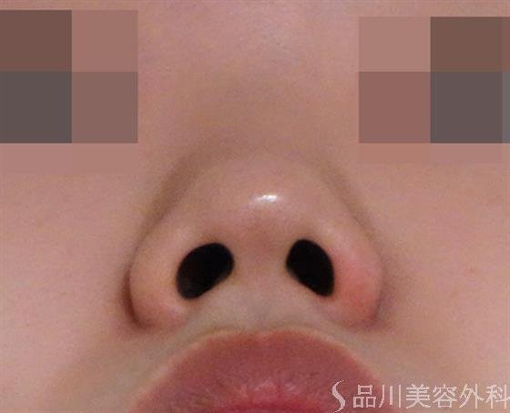 症例NO.40272のBEFORE写真