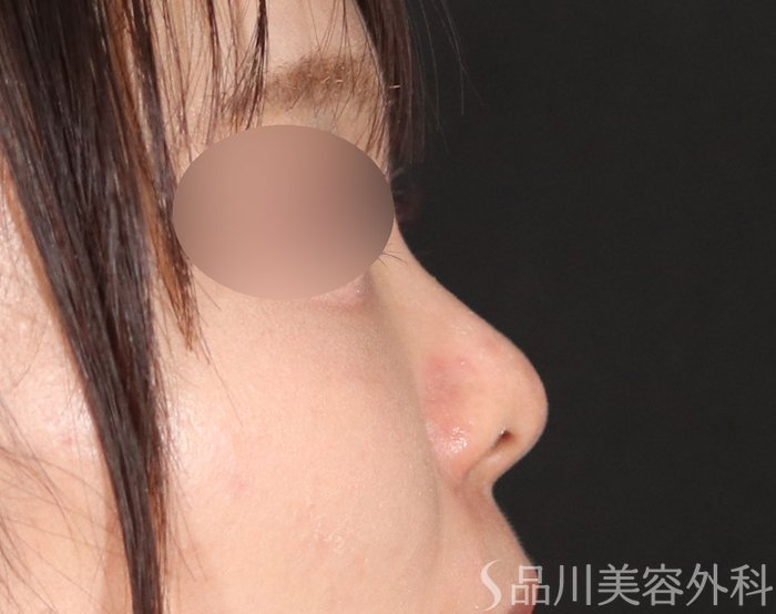 症例NO.72323のBEFORE写真