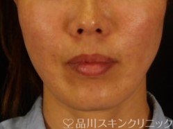 症例NO.72355のAFTER写真