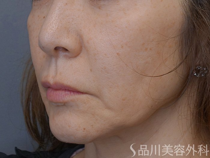 症例NO.74119のBEFORE写真