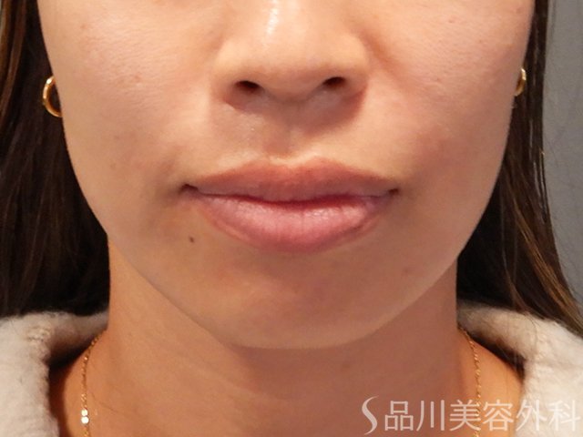 症例NO.72332のAFTER写真