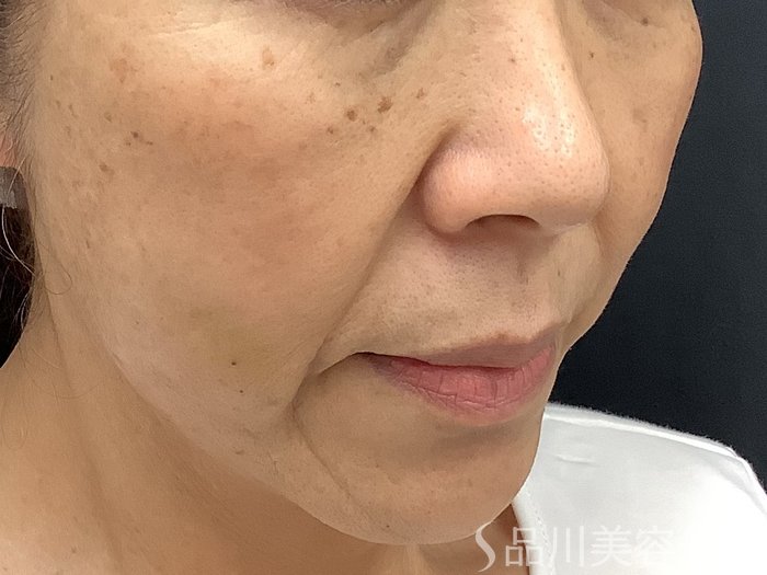 症例NO.68056のAFTER写真