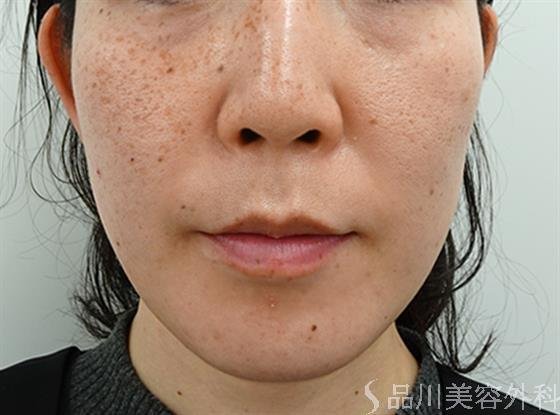 症例NO.46675のBEFORE写真