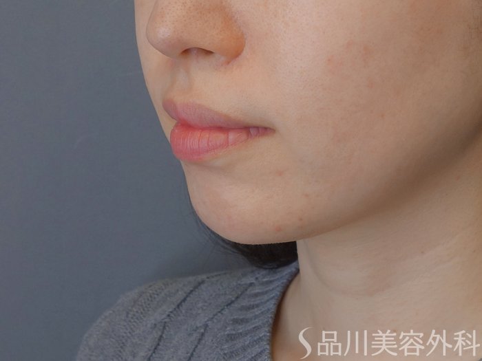 症例NO.72487のBEFORE写真