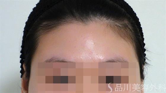 症例NO.46679のBEFORE写真
