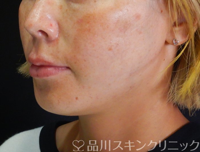 症例NO.66497のAFTER写真