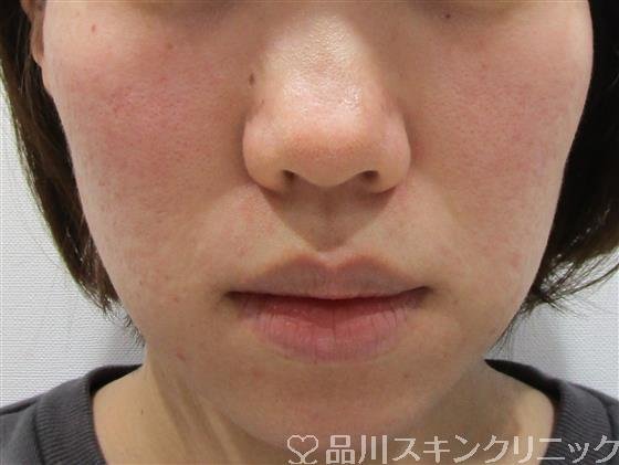 症例NO.42869のAFTER写真