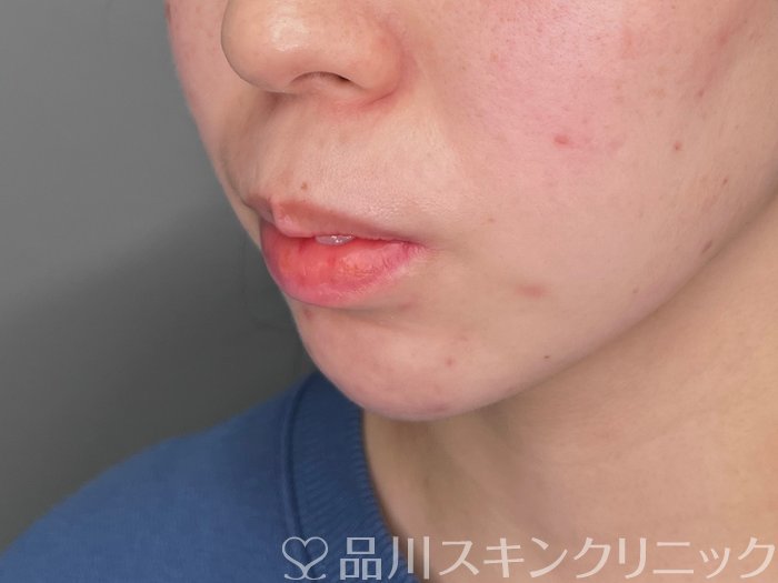 症例NO.70052のBEFORE写真