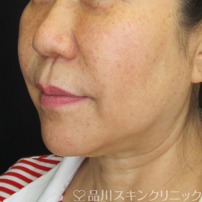 症例NO.74673のBEFORE写真