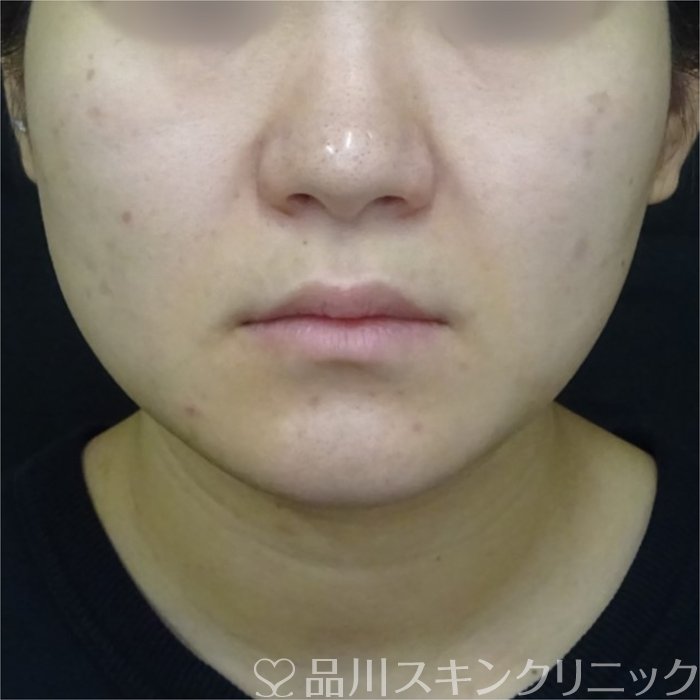 症例NO.69739のBEFORE写真