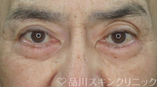 症例NO.70411のAFTER写真