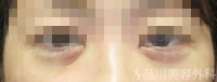 症例NO.75244のAFTER写真