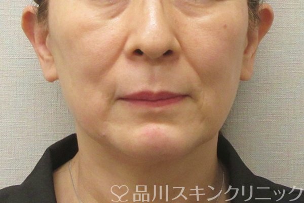 症例NO.74202のAFTER写真