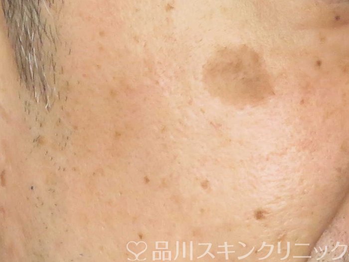 症例NO.65454のBEFORE写真