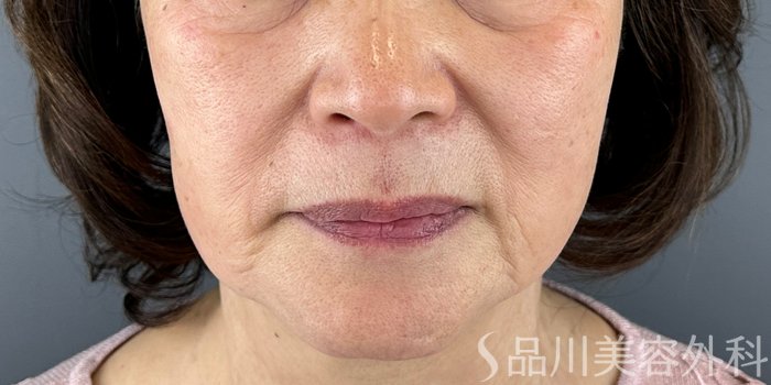 症例NO.72447のBEFORE写真