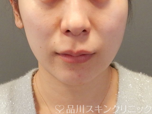症例NO.64028のAFTER写真