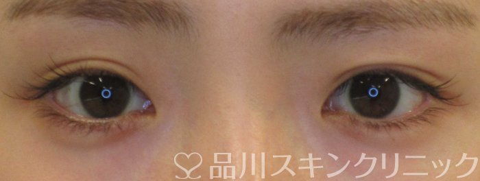 症例NO.68441のBEFORE写真